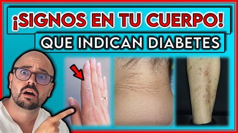 7 SIGNOS VISIBLES en tu CUERPO que indican DIABETES Así COMIENZA la