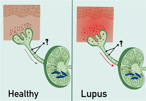 2023 Lupus Highlight The Lrp Presents The Fiscal Year 2021 Idea Award