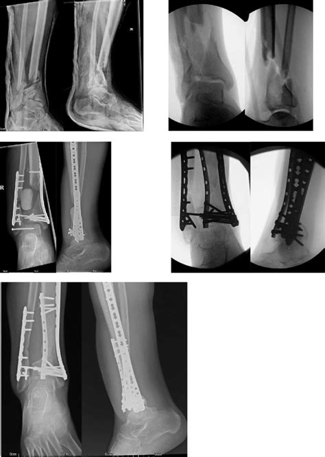 Ap And Lateral Radiographs Of An Open Pilon Fracture Taken On