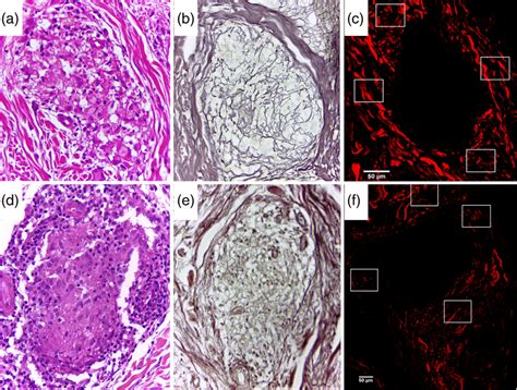 A H E Stain And B Reticulin Stain A H E And Reticulin Staining Of The