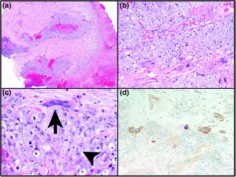 Mediastinal Germ Cell Tumors Basicmedical Key