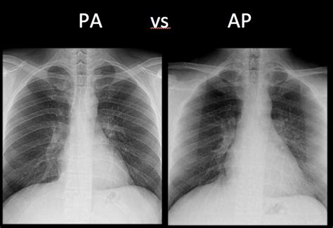 Chest X-Ray Basics: PA vs. AP - radRounds Radiology Network