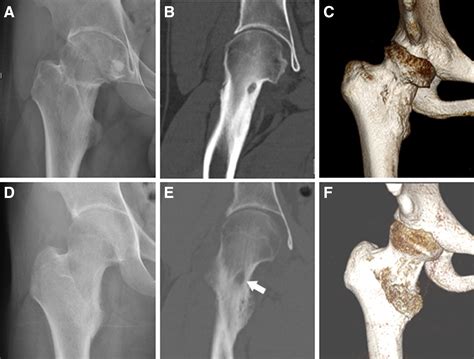 Arthroscopic Excision Of Intra Articular Osteoid Osteoma Of The Hip A