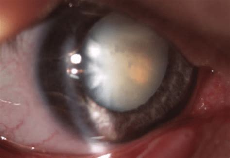 Intumescent Cataract