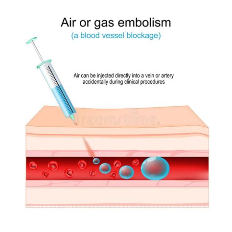 Air Embolism Stock Illustrations 41 Air Embolism Stock Illustrations