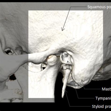 Middle ear anatomy: Epitympanum, mesotympanum, hypotympanum, tegmen... | Download Scientific Diagram