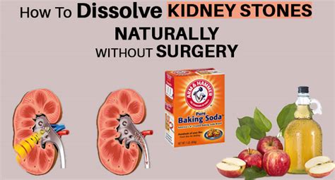 How To Dissolve Kidney Stones Naturally Without Surgery Remedies Lore