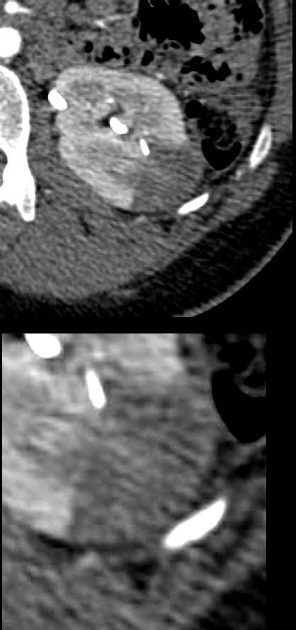 faces  cortical rim sign  common vein