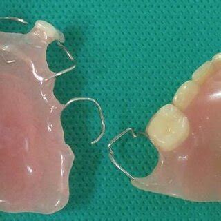 Patient S Serial Panoramic Radiographs Since The Initial Appear Of