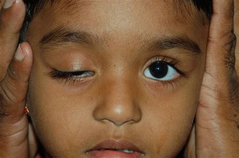 Paediatric Ophthalmology Vasu Eye Institute And Skin Centre