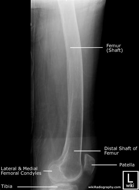 Anatomi Radiografi Femur Radiografer