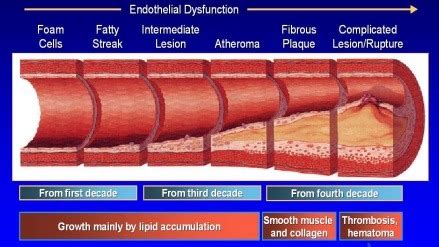 Atherosclerotic Disease Essentials Flashcards Quizlet