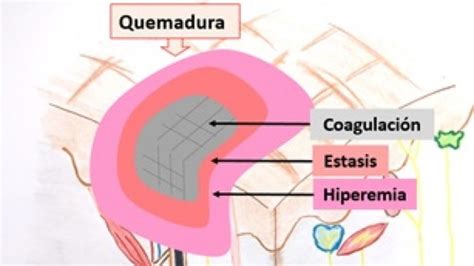 Manejo De Las Quemaduras Por Parte Del M Dico General Flashcards Quizlet