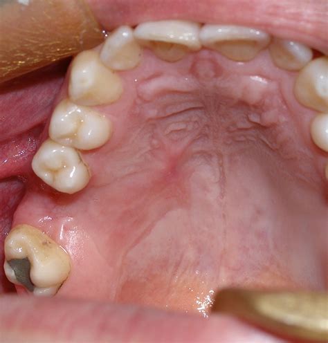 Management Of The Oroantral Fistula Intechopen