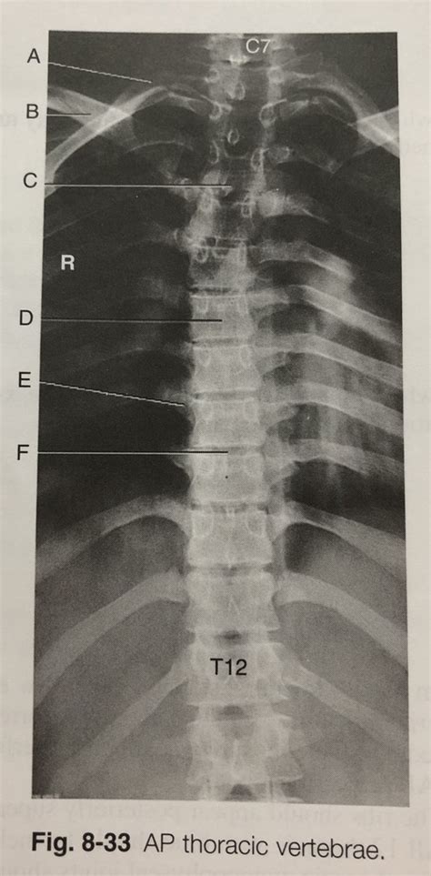 Ap T Spine Diagram Quizlet