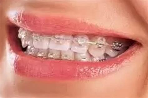 Dental Metal Ceramic Lingual Braces Invisalign Clear Aligners