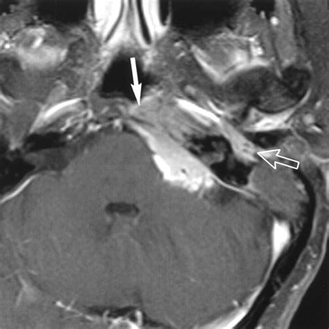 Primary Jugular Foramen Meningioma Imaging Appearance And