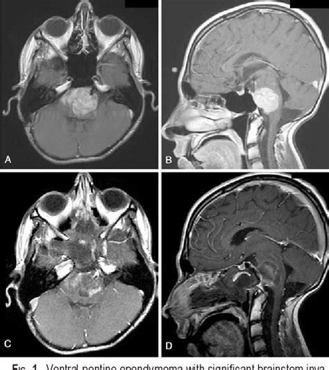 Figure 1 From Endoscopic Endonasal Transclival Approach To A Ventral