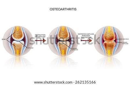 Osteoarthritis Detailed Illustration From Healthy Joint To Damaged