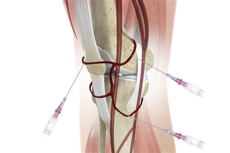 Genicular Nerve Block And Radiofrequency Ablation For Knee Pain