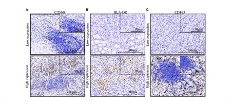 The Expression Of Macrophage Markers In Gastric Cancer A C