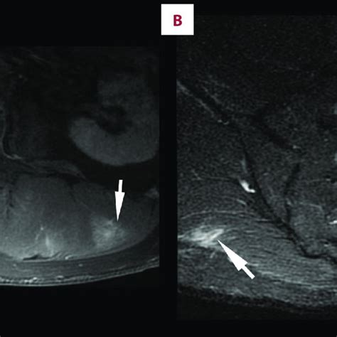 A T1 Weighted Fat Saturated Post Contrast Sequence Axial Image Of