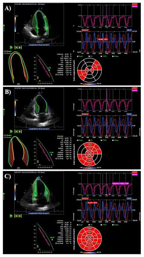 Jcm Free Full Text Reference Ranges Of Left Ventricular Hemodynamic