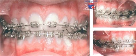 Модифицированная скользящая механика с применением эластиков II класса ...