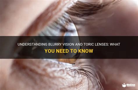 Understanding Blurry Vision And Toric Lenses What You Need To Know