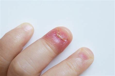 Paronychia Is A Nail Infection Which Is Quite Common It Is