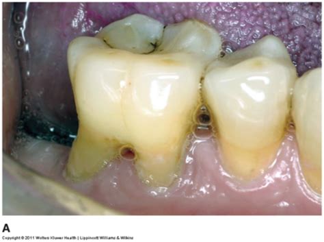 Periodontal Assessment Flashcards Quizlet