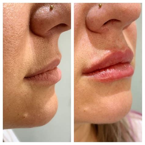 Dermal And Lip Fillers Arden Clinic