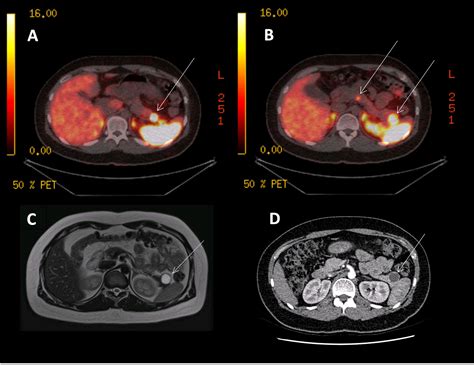 Frontiers The Impact Of Gallium Dota Pet Ct In Managing Patients