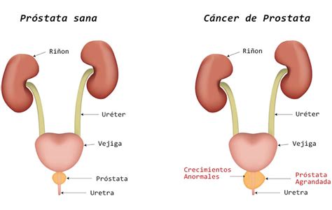 C Ncer De Pr Stata Urolog A Cl Nica Bilbao