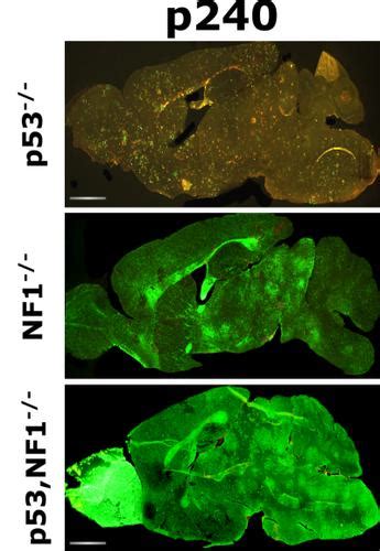 P53 And NF 1 Loss Plays Distinct But Complementary Roles In Glioma