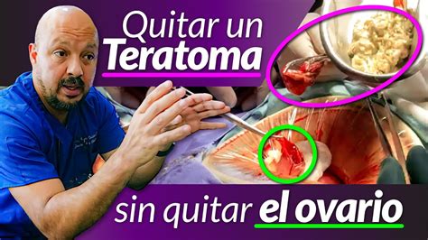 Quitar Un Teratoma Sin Quitar El Ovario Quistes Y Tumores De Ovario