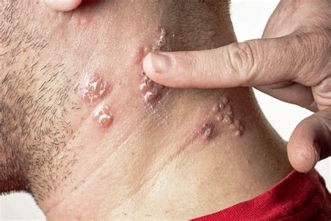 What Does Shingles Look Like Or Feel Like Onset Mild Arms Back