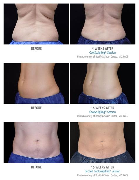 Pin On Coolsculpting