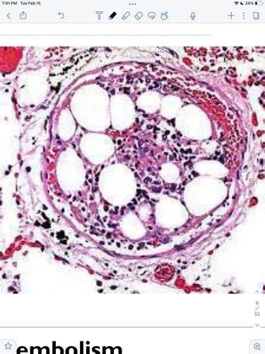 Embolism DIC Infarction Pictures Flashcards Quizlet