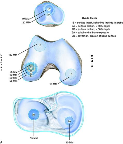 Articular Cartilage Rating Systems Musculoskeletal Key