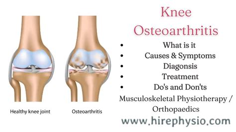 Effective Treatment Options For Knee Osteoarthritis Managing Pain And