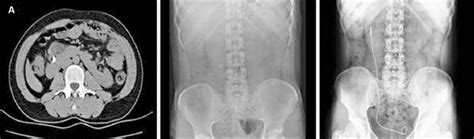 A Preoperative Axial Ct Kub And Postoperative Kub Images Of A