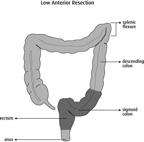 Bowel Resection Canadian Cancer Society