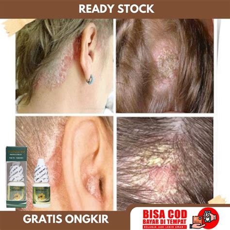 Jual Obat Ketombe Parah Penghilang Koreng Di Kepala Psoriasis Kepala