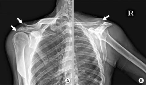 A Anteroposterior Radiograph Of The Right Shoulder Sh Open I