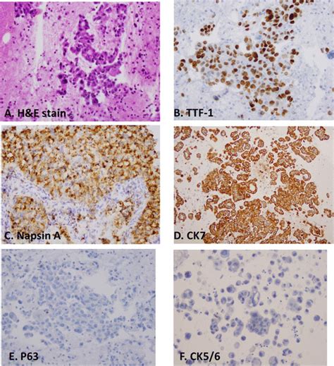 Immunostaining Pattern Of TTF 1 Napsin A And CK7 In Adenocarcinomas