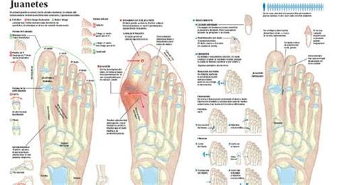 Hallux Valgus O Juanete Qué Es Síntomas Diagnóstico Y Tratamiento Clínica Universidad De Navarra