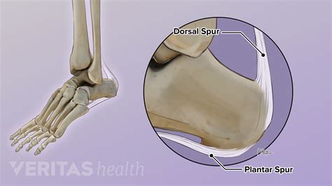 The 2 Common Types Of Heel Spurs Insertional Achilles Tendonitis Types Of Heels Heal Spurs