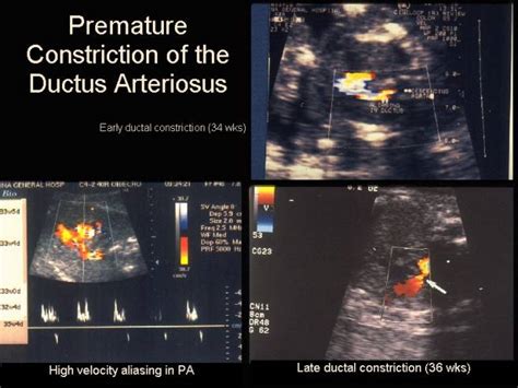 Abnormal Waveforms In The Ductus Arteriosus