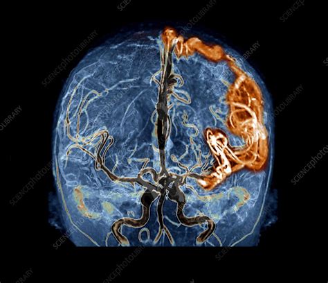 Cerebral Arteriovenous Malformation D Ct Scan Stock Image C